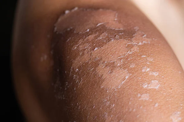 Man Suffer Sunburned Skin Close — Stock Photo, Image