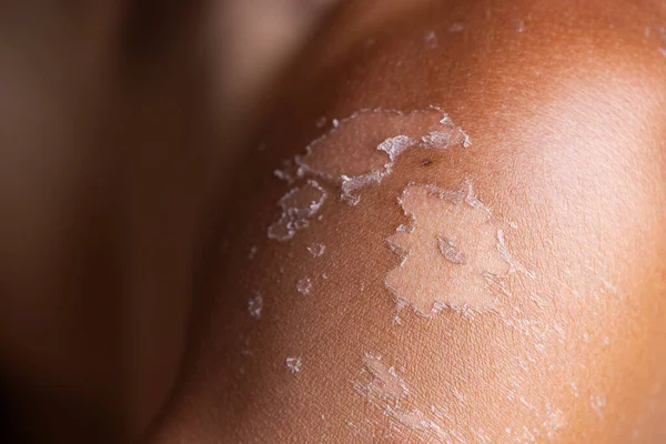 Man suffer from sunburned skin close up