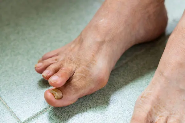 Asian Woman Suffer Serous Hallux Valgus Feet Toe — Stock Photo, Image