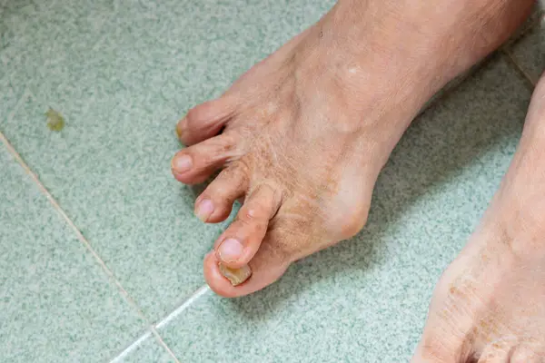 Asiática Mujer Sufren Seroso Hallux Valgus Sobre Los Pies Dedo —  Fotos de Stock
