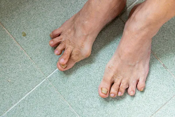 亚洲女人脚趾头涂满了血淋淋的Hallux Valgus 图库照片