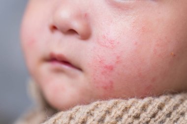 Görünür egzama ve kızarıklıkla bebek yanakları