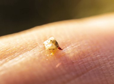 Bir arı bir erkeğin parmağını soktu. İnsan vücudunda kalan arı hareket etti ve şişeden zehir saldı.