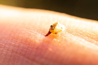 Arı sokması insan vücudundan çıkarmaya çalışıyor..