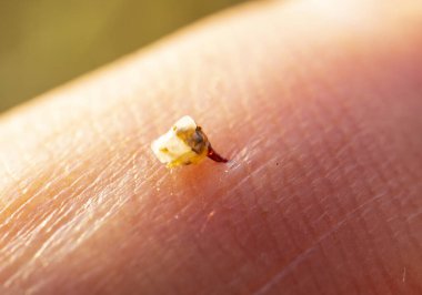 Arı sokması insan vücudundan çıkarmaya çalışıyor. Arı sokması insan vücudundan çıkarmaya çalışıyor..