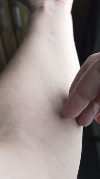 코카서스 남성의 측면에 가려운 온화한 알레르기 발진을 — 비디오