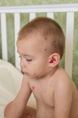 Beşikte battaniyeye sarılmış suçiçeği isiliği olan 1,5 yaşında hasta bir çocuk. Çocukluk hastalığı, evde bakım ve pediatrik sağlık kavramı.