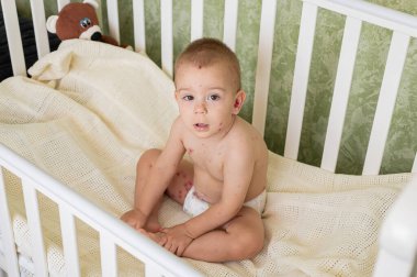 Beşikte battaniyeye sarılmış suçiçeği isiliği olan 1,5 yaşında hasta bir çocuk. Çocukluk hastalığı, evde bakım ve pediatrik sağlık kavramı.