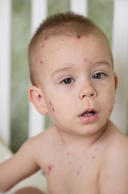 Beşikte battaniyeye sarılmış suçiçeği isiliği olan 1,5 yaşında hasta bir çocuk. Çocukluk hastalığı, evde bakım ve pediatrik sağlık kavramı.