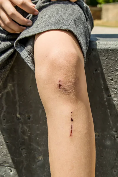 Abrasão Cicatrizante Perna Adolescente — Fotografia de Stock