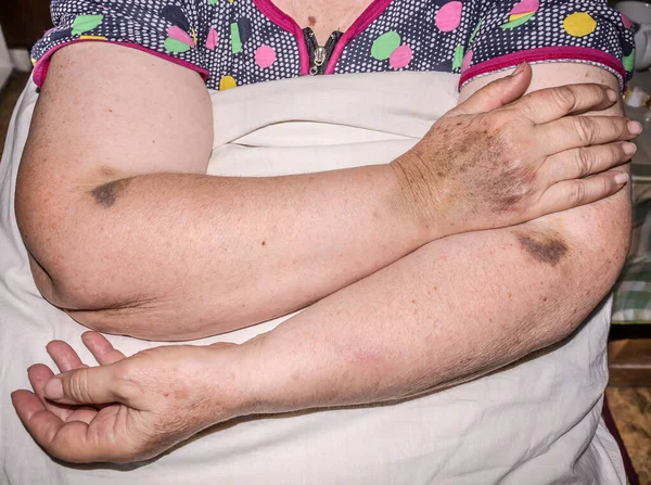 Mano Una Donna Anziana Con Ematomi Dopo Iniezione Endovenosa — Foto Stock
