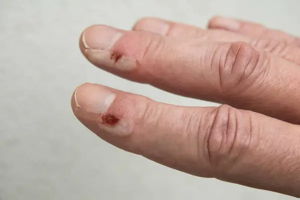 Fingers with burn the skin and fingers injuries. Close up image.