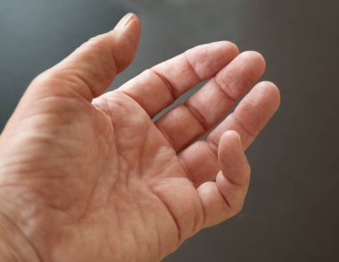 Dupuytrens kasılması olan birinin eli. Bir ya da daha fazla parmağının bükülmüş bir pozisyonda kalıcı olarak büküldüğü bir durum. İşte serçe parmak, avuca doğru bükülmesine neden oluyor..