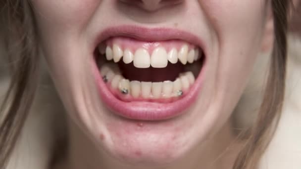 Close Caucasian Woman Chin Mouth Girl Yawns Correction Bite Young — Stock Video