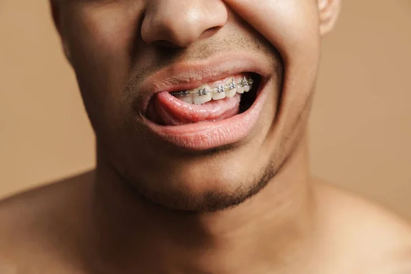 Młody Włosie Człowiek Pokazując Jego Stomatologiczne Aparat Ortodontyczny Język Odizolowane — Zdjęcie stockowe