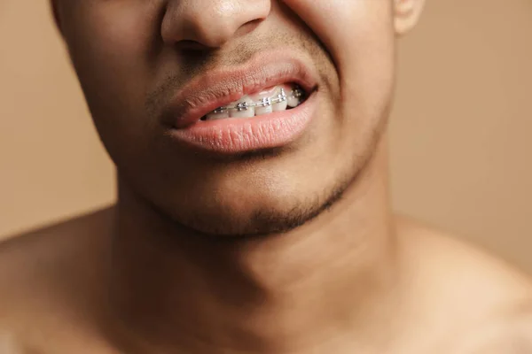 Hombre Cerda Joven Mostrando Aparato Dental Cámara Aislado Sobre Fondo —  Fotos de Stock