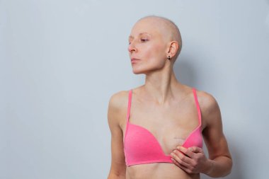 Saçları olmayan, pembe bluzlu bir kadın, cerrahi mastektomi izi gösterir, tarafsız bir arkaplan önünde durur.