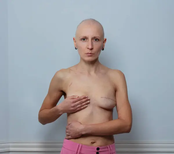 stock image Bald individual with a serious expression stands against a light blue backdrop, holding one hand over her chest, show mastectomy scar