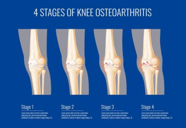 Diz eklemi osteoartriti aşamaları, kemik kıkırdak eklem iltihabı hakkında tıbbi bilgiler, vektör bacak sağlığı. Diz eklemi osteoartrit hastalığı belirtileri, diz kıkırdağı iltihabı hakkında bilgi