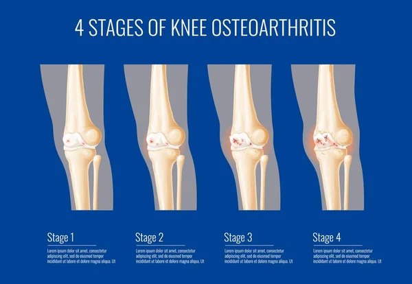Estágios Osteoartrite Nas Articulações Joelho Infográficos Médicos Sobre Artrite Cartilagem —  Vetores de Stock