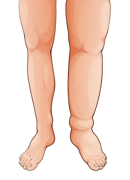 足と足の腫れEdema リンパ浮腫 浮腫病症状 足の流体保持 リンパ循環障害および体組織炎症または血栓症症候群医療ベクトル図 — ストックベクタ