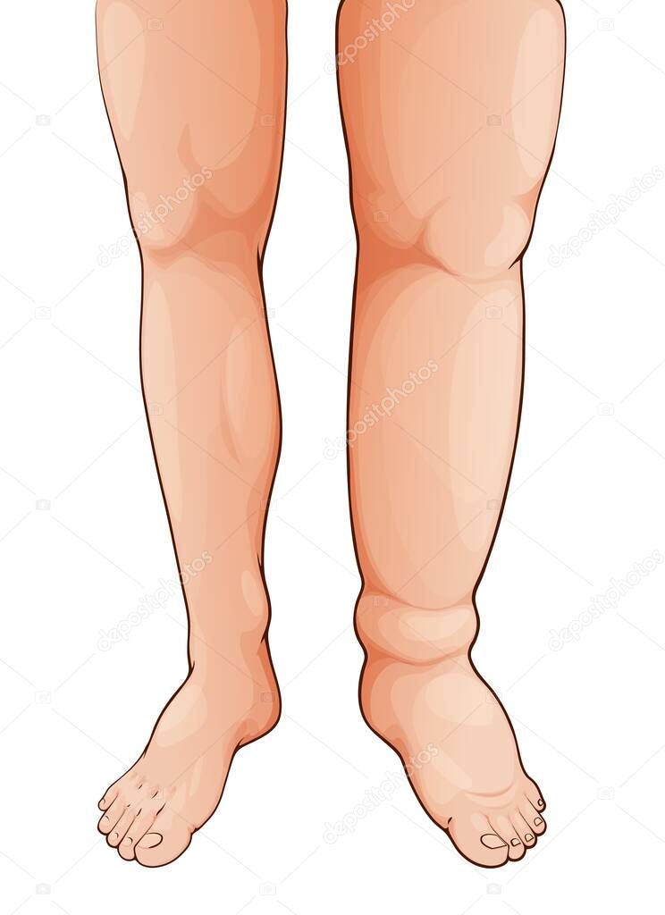 Edema hinchado pierna y pie. Linfedema. Síntoma de la enfermedad de