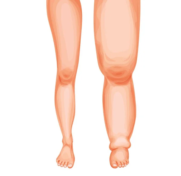 エデマ フット 腫れた足と足首 リンパ系のベクトルリンパ浮腫やリンパ浮腫病 漫画の人間の足の比較 健康と腫れ足 体液貯留 リンパ循環の問題 — ストックベクタ