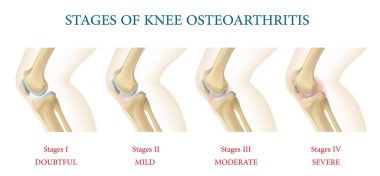 Tıbbi bilgi grafikleri. Diz eklemi osteoartrit aşamaları, insan vücudunun diz kemikli vektör çizelgesi, sağlıklı ve seyreltilmiş kıkırdak. Eklem ağrısı, kemik iltihabı belirtileri.