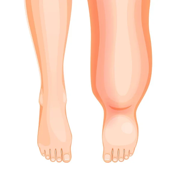 Ödem Ayağı Şişmiş Bacak Semptomu Akışkan Tutma Tromboz Bacaklarda Doku — Stok Vektör