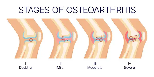 Knie Osteoartritis Stadia Menselijke Kniegewrichten Botten Anatomie Vector Medische Diagram — Stockvector