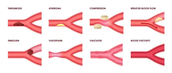 stock vector Vein diseases of thrombosis, atheroma and vasculitis with blood viscosity, vector medical infographic icons. Vein diseases of vascular artery compression, vasospasm, embolism and reduced blood flow