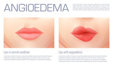 Anjiyoödem ya da ödem şişmesi yüzünden şişmiş dudaklar, vektör tıbbi bilgi. Alerji ya da bağışıklık hastalığından kaynaklanan anjiyoödem ya da anjiyoevrizma ödemi olan normal ve şişmiş dudaklar.