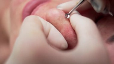 Kozmetik, sivilce ve deri problemi. Kozmetikçiler siyah başlık ve sivilceleri paslanmaz çelik sivilce çıkarıcı aletle sıkıyor. Burun deliklerinden beyaz sivilceler çıkıyor. Makro görünüm