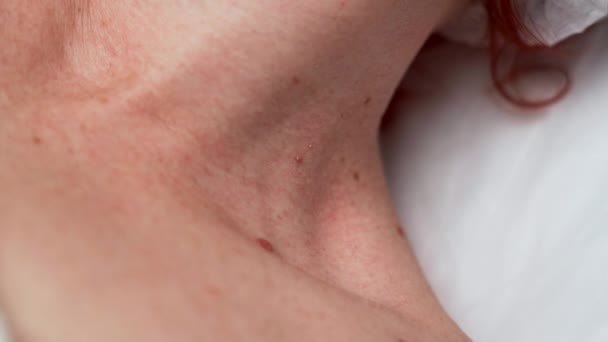 女性の首のレーザーを使用して小さなパピローマを除去する化粧品学者は 皮膚を燃やし クローズアップビュー 外科手術について パピローマまたは出生マークを削除する クローズアップ — ストック動画
