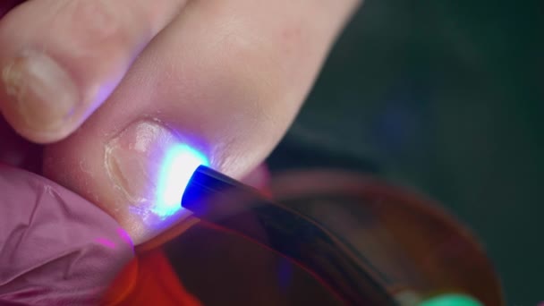 기형의 정형외과 의사는 발톱에 죔쇠를 접착제를 강하게 위하여 자외선 램프로 — 비디오