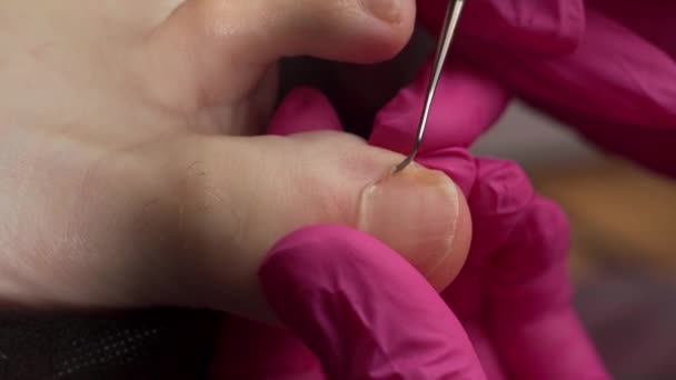 Podolog Roze Handschoenen Verwijdert Nagel Nagels Met Behulp Van Hardware — Stockvideo