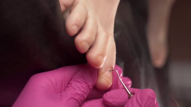 釘の器械を使用して専門の医学のペディキュア プロシージャ カイロプラジストの表彰台を訪れる患者さん クローズアップ — ストック動画