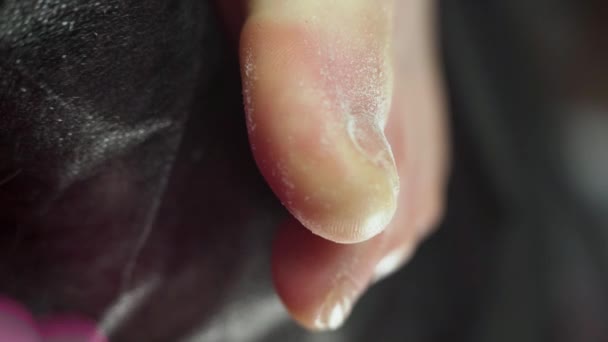 Doctor Removes Onycholysis Toenail Damaging Tight Shoes Using Gel Lacquer — Stock Video
