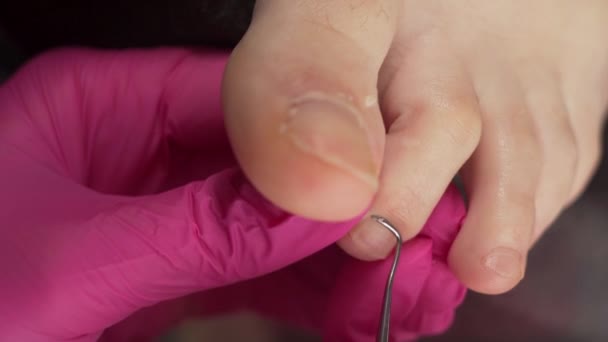 Pedicure Podologist Pendekatan Prosedur Pedikur Penyakit Kuku Dan Menghapus Kutikula — Stok Video