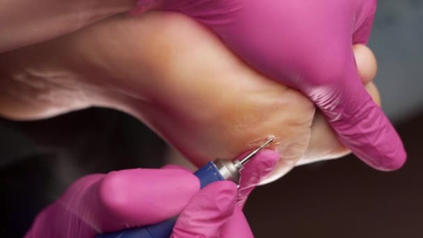 Chiropodist Ροζ Goves Κάνει Υλικό Ξεφλούδισμα Του Δέρματος Του Γυναικείου — Αρχείο Βίντεο