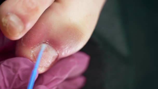 기형의 정형외과 의사가 발톱에 클램프에 손톱을 비디오 — 비디오