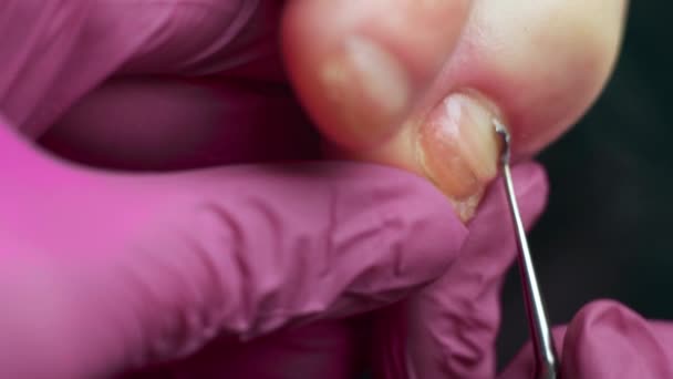 Podiatrist Treating Toenail Fungus Cleans Cuticle Nail Podology Treatment Concept — Stock Video