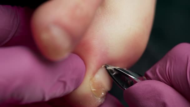 Ein Podologe Behandelt Einen Kranken Deformierten Nagel Mit Pilz Schneidet — Stockvideo