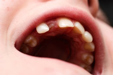 Bir ortodontist tarafından tedavi edilmeden önce bir çocuğun dişlerinin yakın plan çekimi.