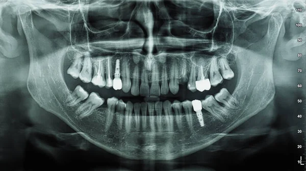 Orthopantomogramm Einzelbild Röntgenaufnahme Von Unterkiefer Oberkiefer Und Zähnen — Stockfoto