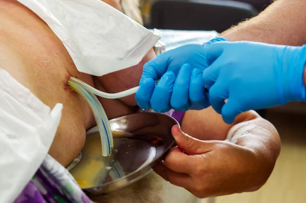 Nahaufnahme Der Hand Des Arztes Während Chirurg Und Assistent Operieren — Stockfoto