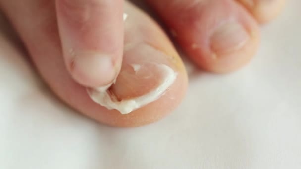 Salbe Anwenden Pilz Auf Zehe Krankheit Auf Zehen Salbe Auf — Stockvideo