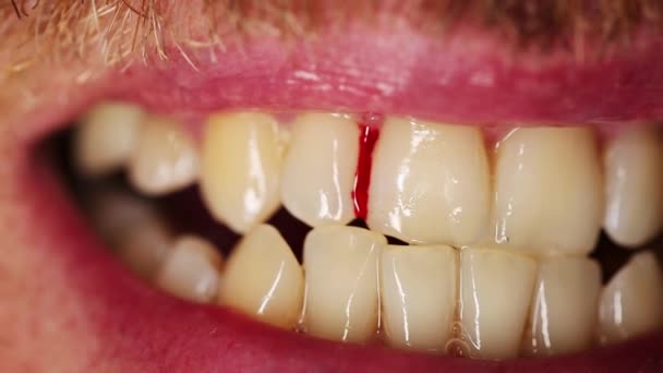 Sang Des Gencives Près Dent Dentiste Dentiste — Video