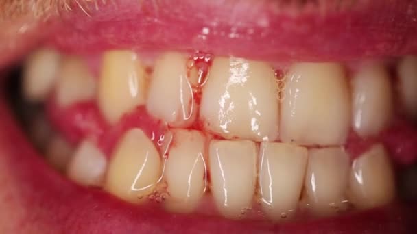 牙医在牙医预约时 因牙龈酸痛而流血 — 图库视频影像