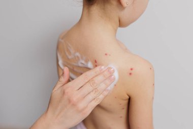Child back infected with chickenpox is having treatment using antiseptic foam by hand clipart